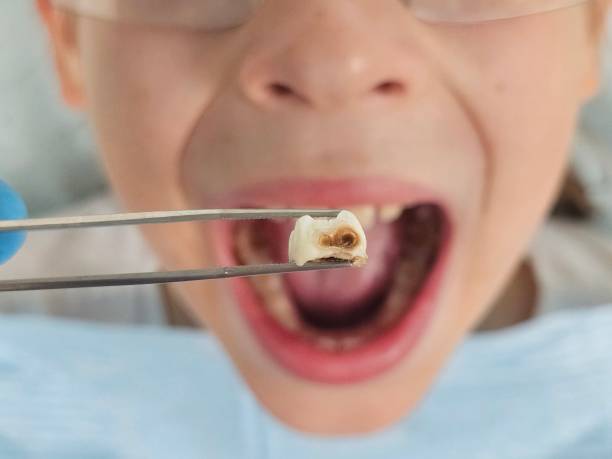 Best Pediatric Emergency Dentist in Great Bend, NY